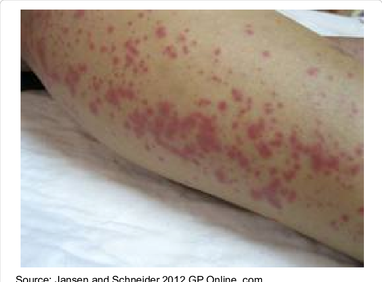 Download Clip Art Download Scientific Diagram - Leptospirosis Skin Rash ...