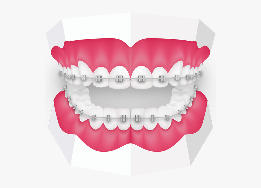 Fixed Braces At Toothbeary - Orthodontics Png, Transparent Clipart