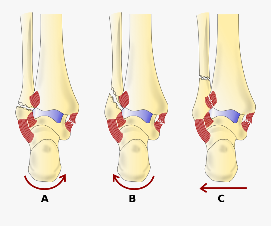 Danis Weber Classification Wikipedia - Dennis Weber Classification, Transparent Clipart
