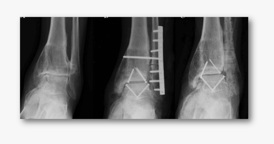 Cartilage Repair Www Lowerextremity - Ankle Xray No Cartilage, Transparent Clipart