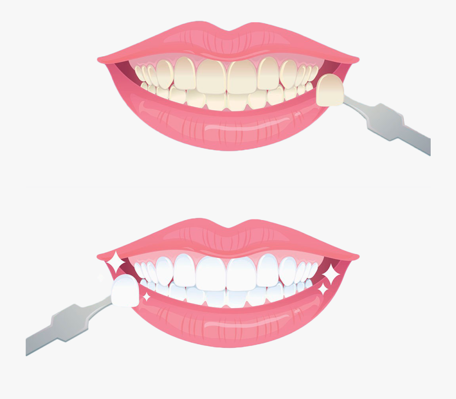 Tooth Whitening Euclidean Vector - Teeth Whitening Background, Transparent Clipart