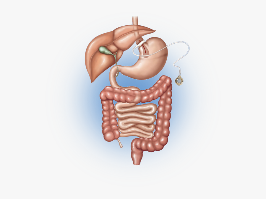 Vertical Sleeve Gastrectomy, Transparent Clipart