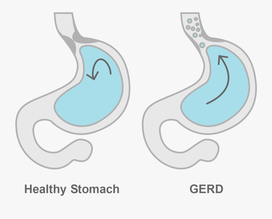 Healthy Stomach And Gerd Stomach, Transparent Clipart
