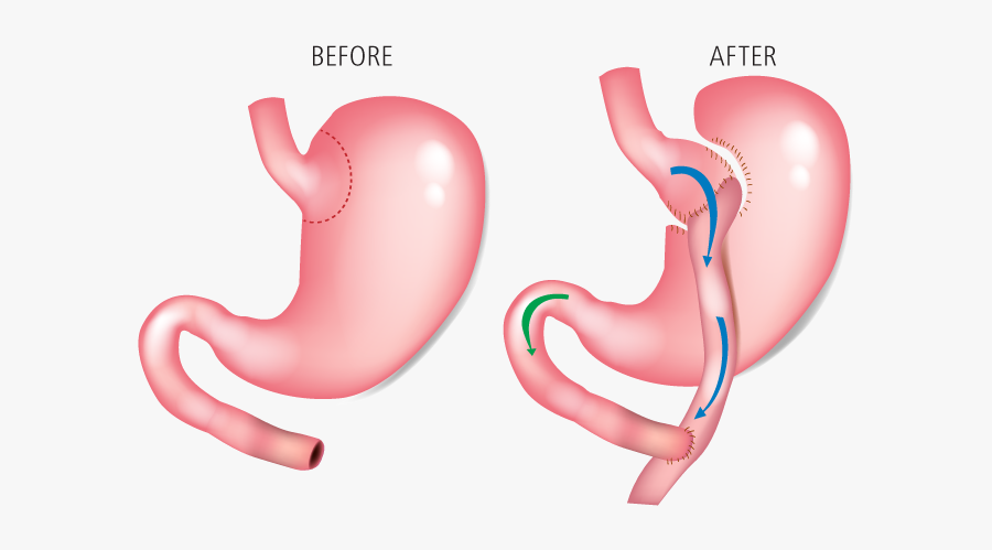 Gastric Bypass - Cirurgia De Bandagem Gástrica, Transparent Clipart