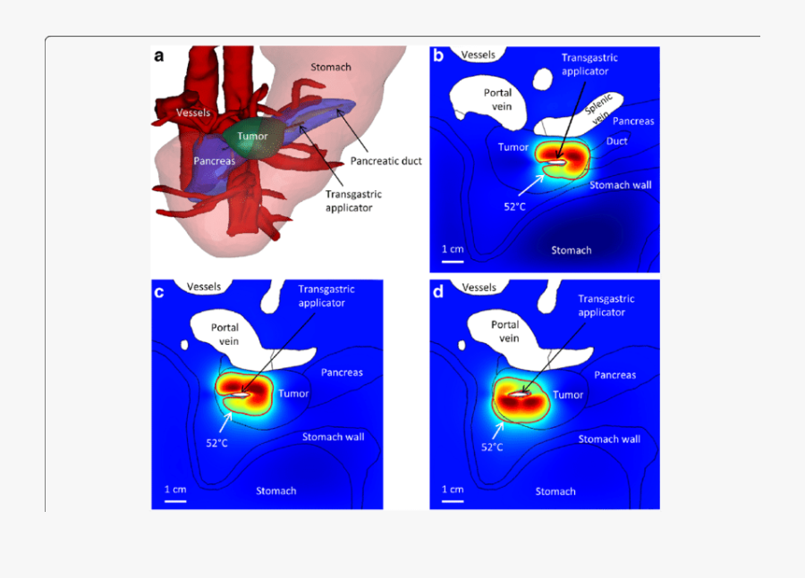 A 3d Image Of Anatomy Showing Position Of Large Tumor - Cartoon, Transparent Clipart
