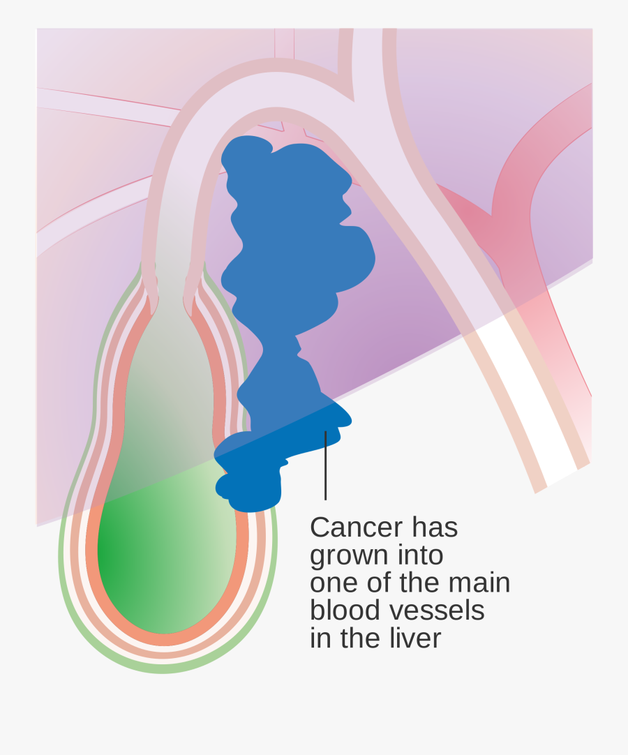 Transparent Chromosome Clipart - Types Of Gallbladder Cancer, Transparent Clipart