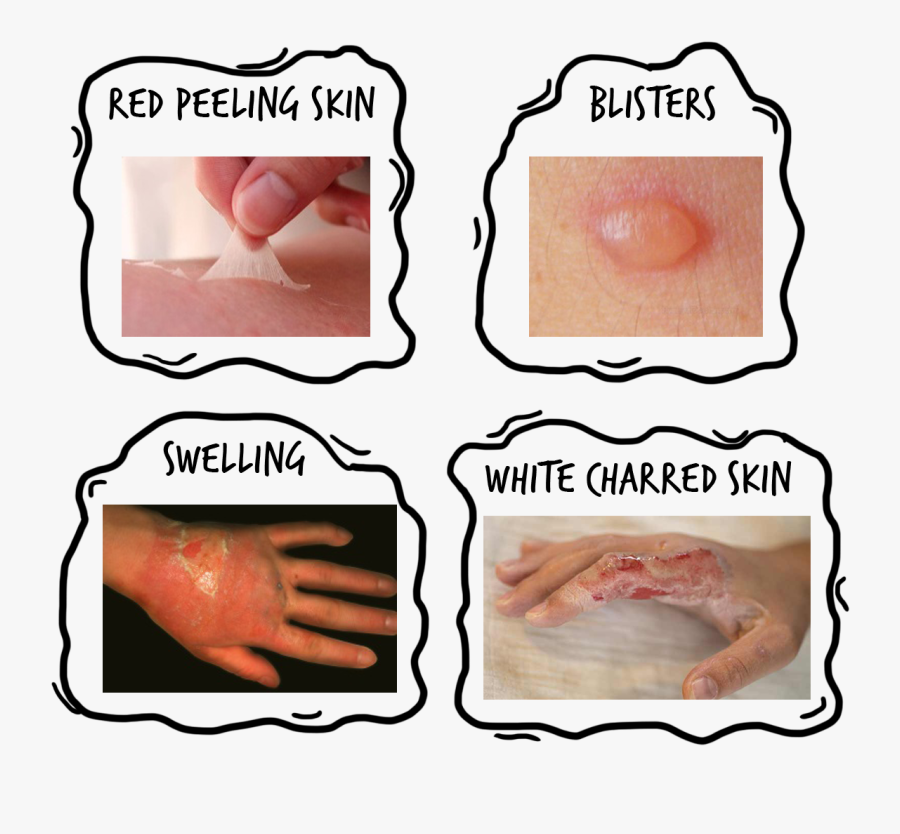Treating Burns And Scalds Remember Ccc - Burns And Scalds, Transparent Clipart