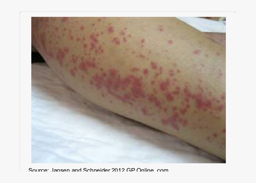 Clip Art Download Scientific Diagram - Leptospirosis Skin Rash, Transparent Clipart