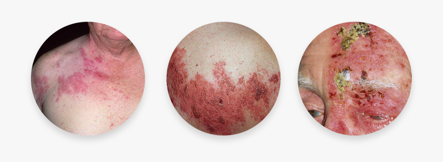 Shingles Rash Png - Shingles On The Head, Transparent Clipart