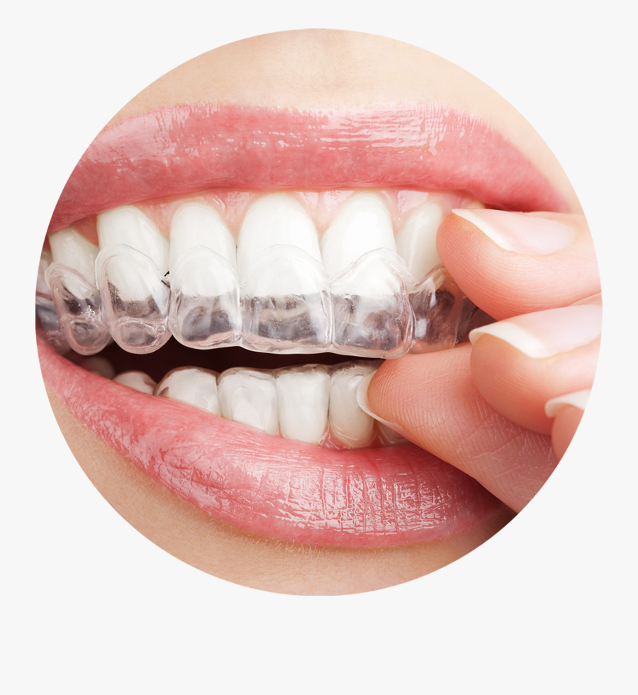 Transparent Teeth With Braces Clipart - Sensitive Teeth Treatment, Transparent Clipart