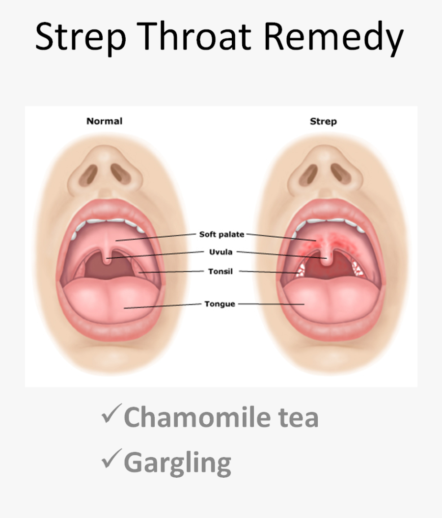 Clip Art Best Prooven Home Remedy - Early Stage Gonorrhea In Mouth, Transparent Clipart