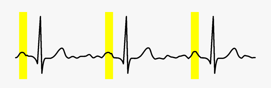 Transparent Sinus Rhythm Clipart - Plot, Transparent Clipart