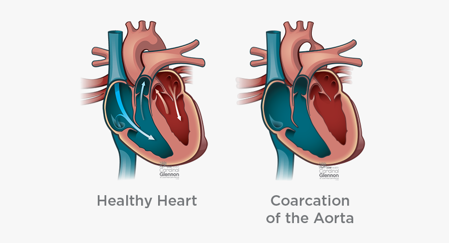 Coarcation-aorta - Truncus Arteriosus, Transparent Clipart