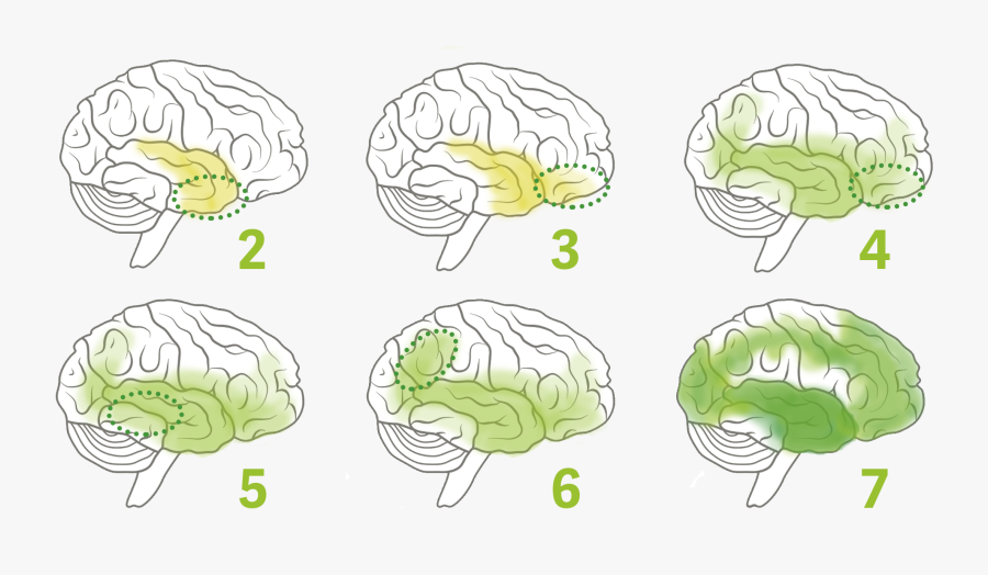 Brain Clipart Dementia - Brain Stages Of Dementia, Transparent Clipart
