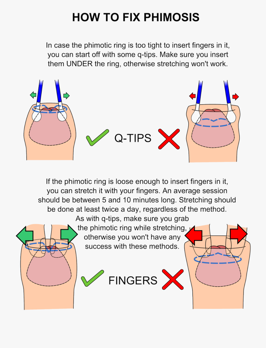 Phimosis Stretch, Transparent Clipart