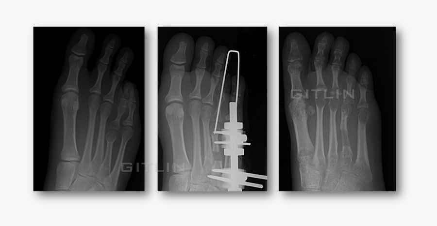 Clip Art Brachymetatarsia Www Lowerextremity Com - Radiography, Transparent Clipart