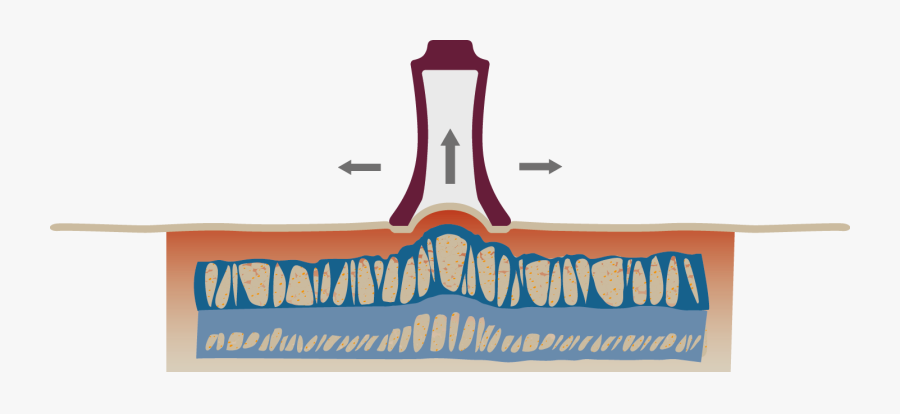 Faszio® Cupping, Die Neue Form Des Schröpfens, Faszio® - Illustration, Transparent Clipart
