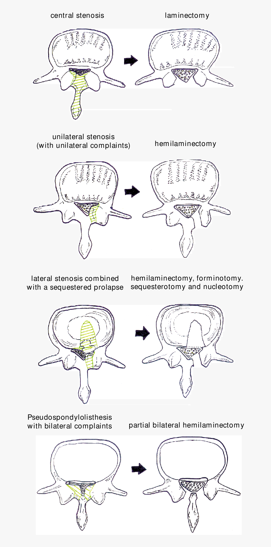 Microsurgical Procedures In Dierent Kinds Of Spinal - Cartoon, Transparent Clipart