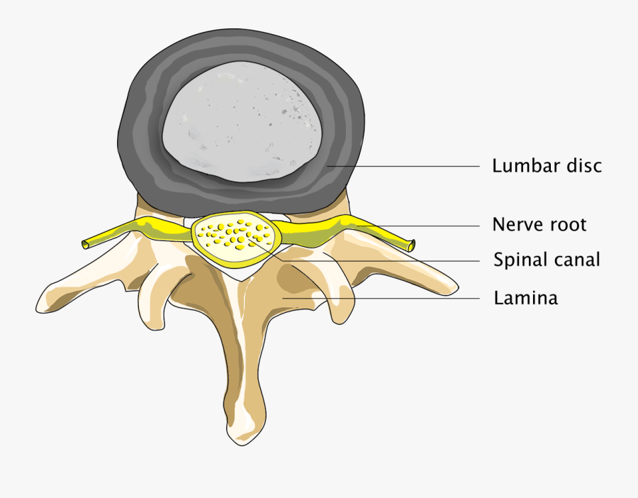 Normal Person - Spinal Hernia, Transparent Clipart