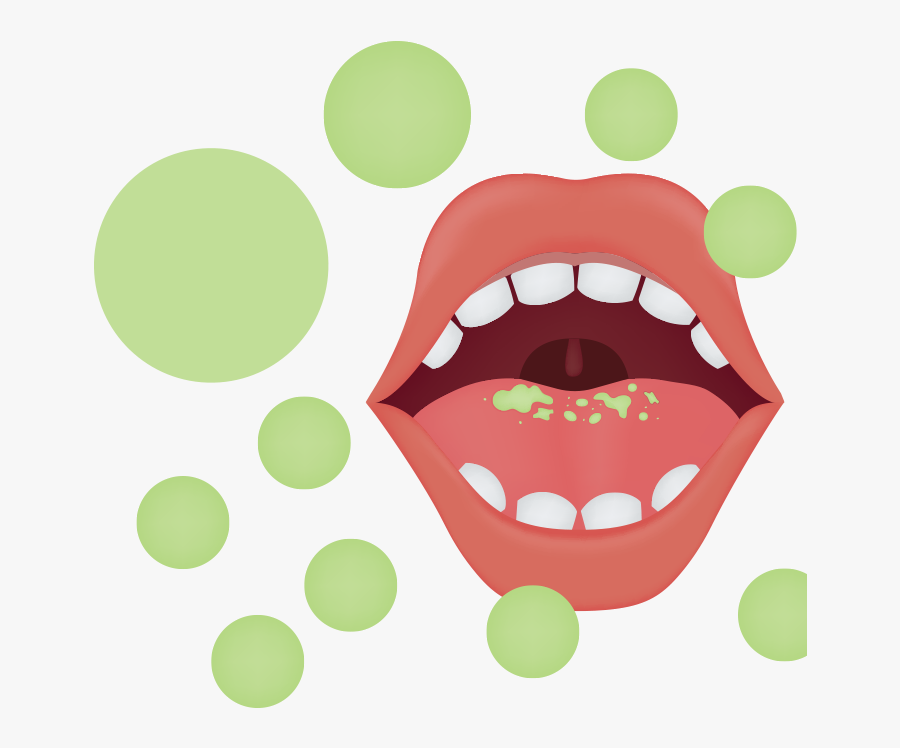 Removing Tonsils Procedure, Transparent Clipart