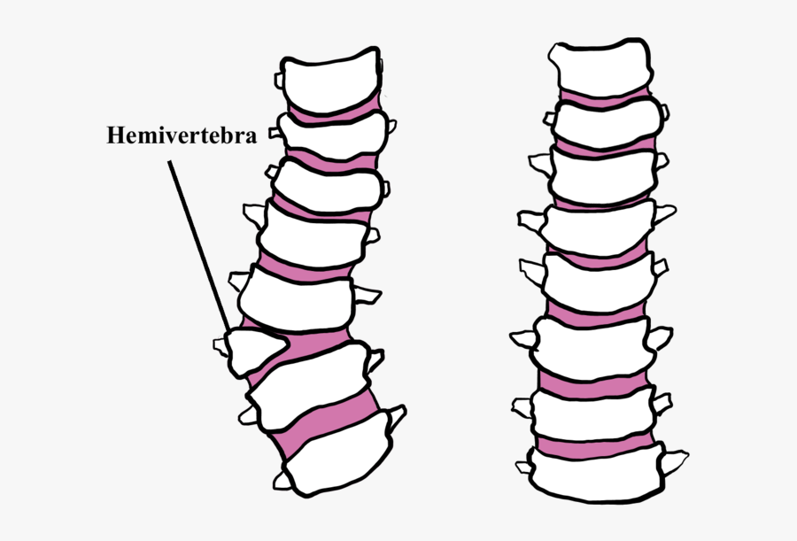 Hemivertebrae In Pugs Symptoms, Transparent Clipart