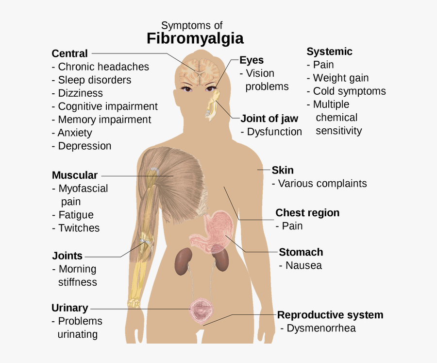 Clip Art Equilibrium Natural Health Fibromyalgia - Woman Fibromyalgia Trigger Points, Transparent Clipart