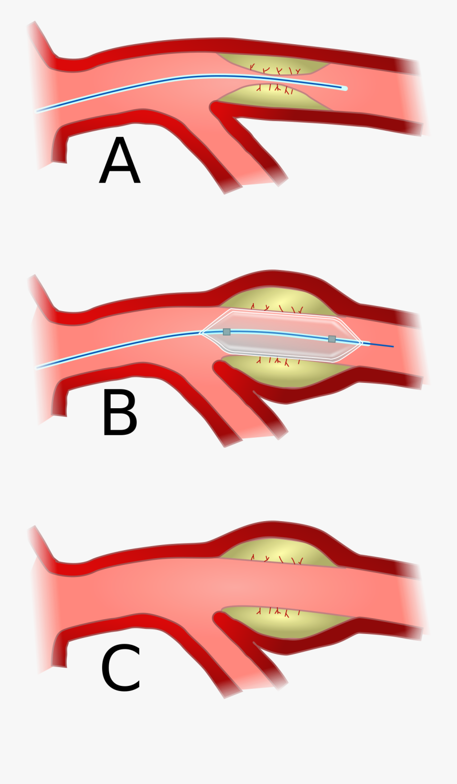 Statistics On Cardiovascular Disease In Australia, Transparent Clipart