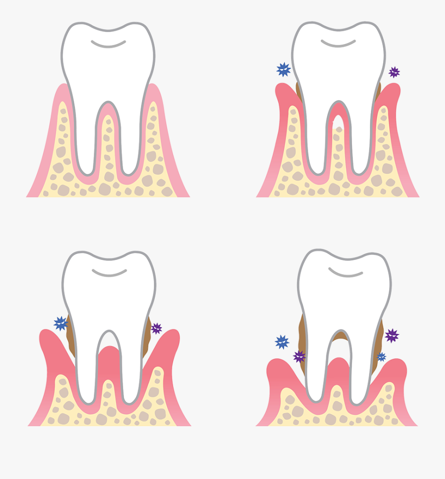 How Periodontal - Dental Periodontal, Transparent Clipart
