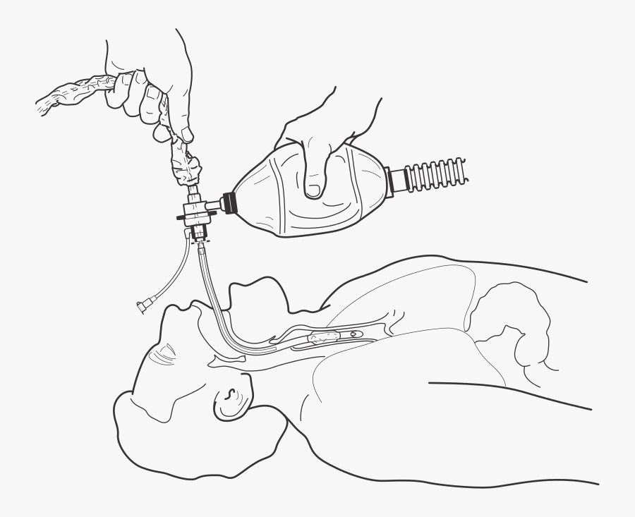 Endotracheal Procedure - Line Art, Transparent Clipart