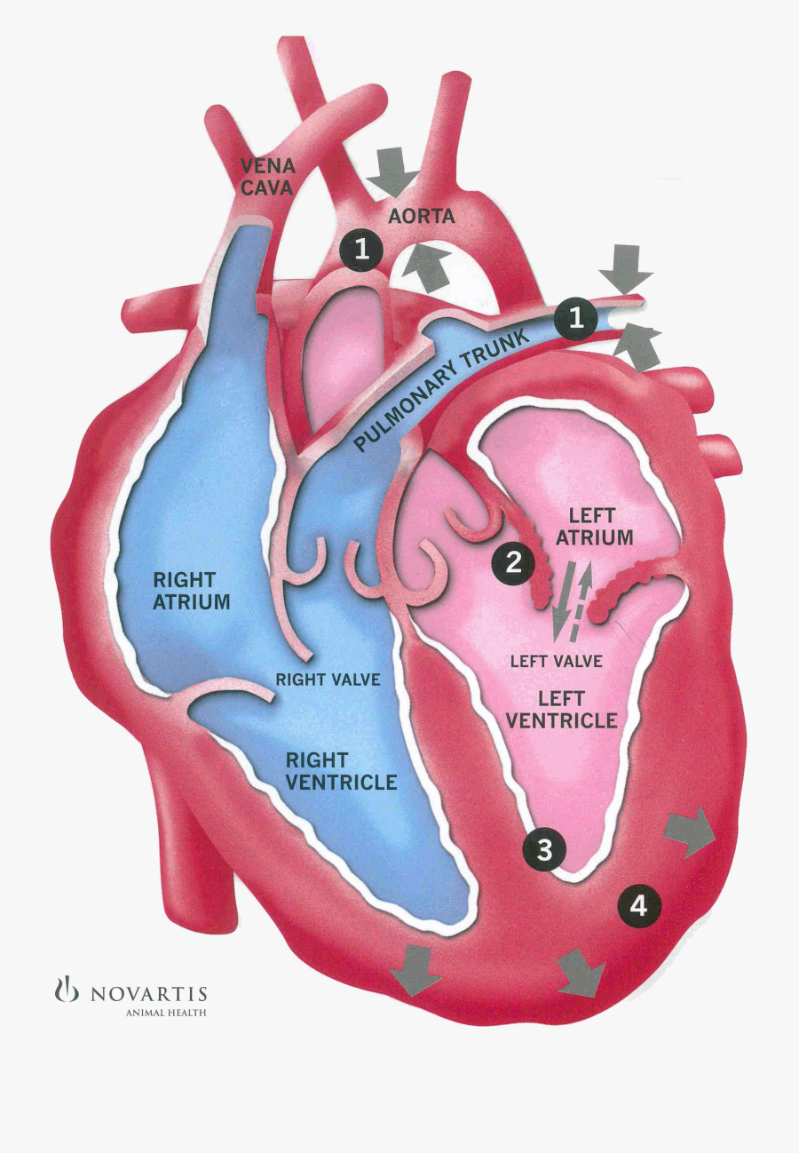 Clip Art Congestive Heart Failure Picture - Congestive Heart Failure Damage, Transparent Clipart