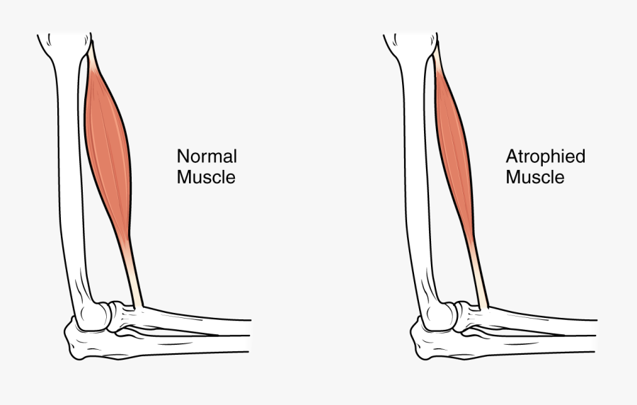Clip Art A More Detailed Look - Muscle Atrophy, Transparent Clipart