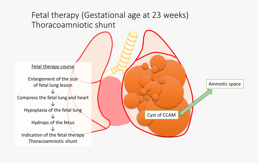 Clip Art 4 Month Fetus - 先天 性 嚢胞 性 腺腫 様 奇形, Transparent Clipart