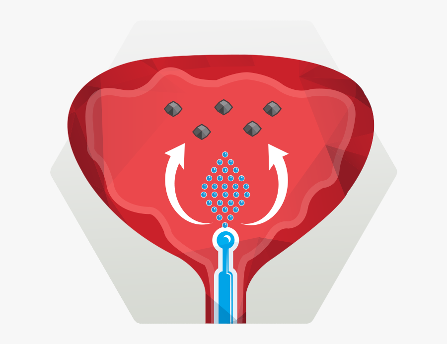 Catheter Associated Urinary Tract Infections - Illustration, Transparent Clipart