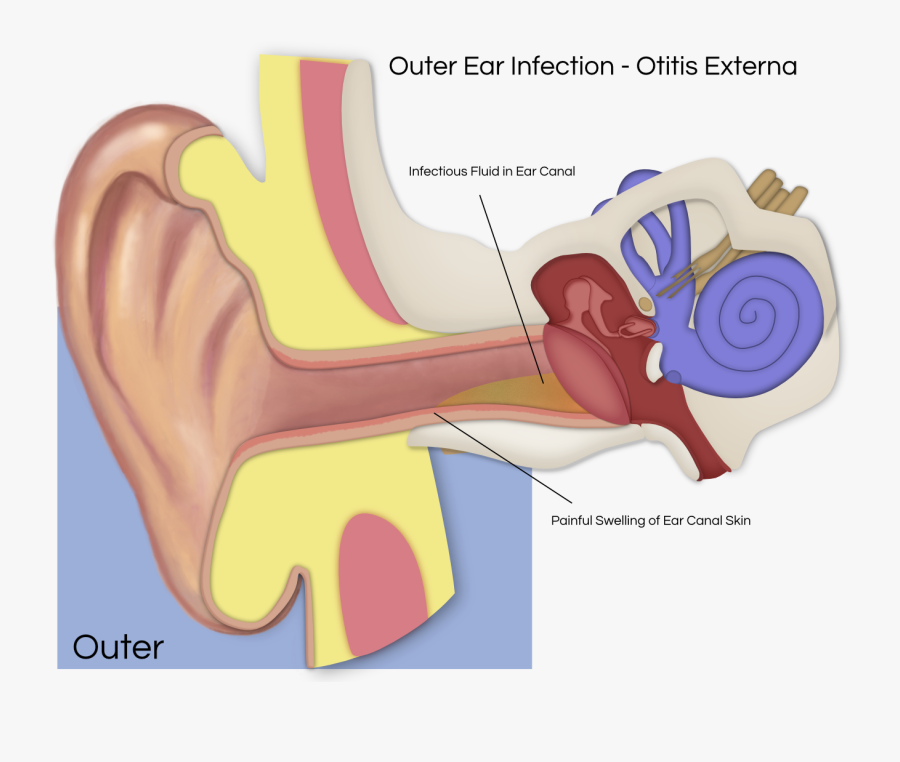 Transparent Infection Clipart - Vestibular Schwannoma Affected Nerves, Transparent Clipart