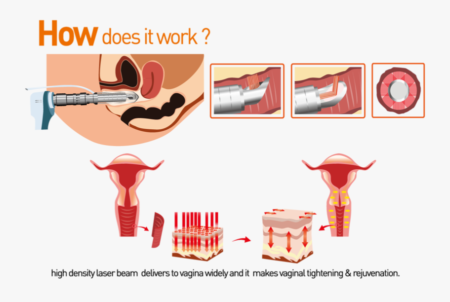 Dental - Laser Labia Tightening, Transparent Clipart