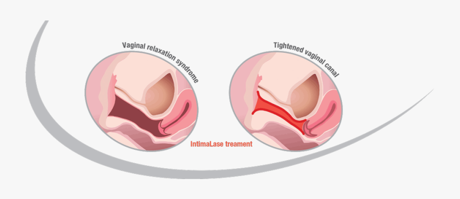 Feminine Rejuvenation Before And After, Transparent Clipart