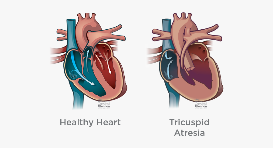 Tricusp#atresia - Truncus Arteriosus, Transparent Clipart