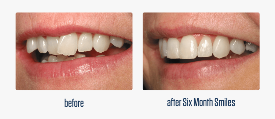 Transparent Smiling Mouth Clipart - Six Month Smiles, Transparent Clipart