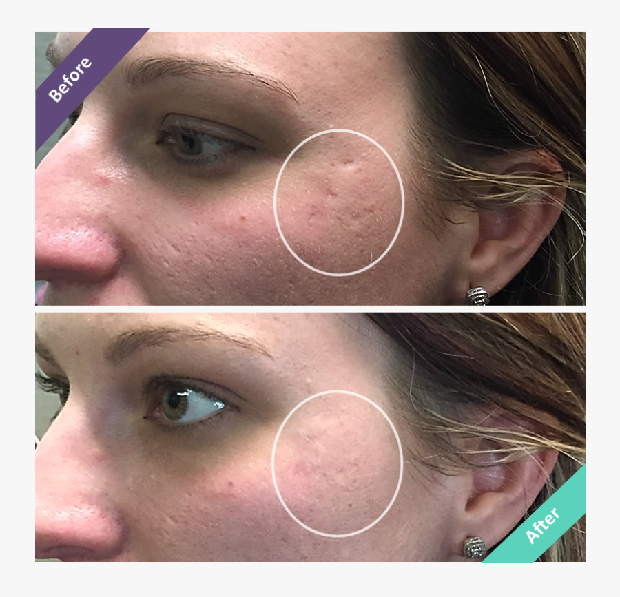 Clip Art Pretty Girls With Acne - Filler For Ice Pick Scars, Transparent Clipart