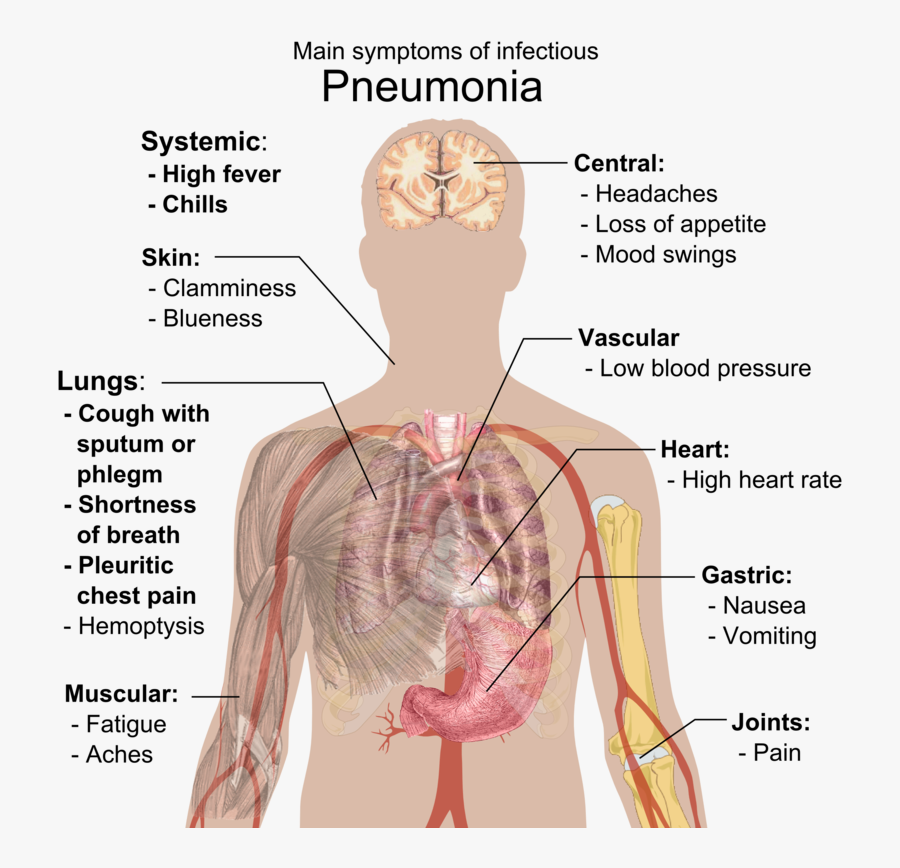 Main Symptoms Of Infectious Pneumonia, Transparent Clipart