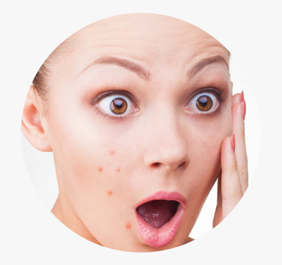 Acne Face Cure Skin Boil Care Clipart - Acne Png, Transparent Clipart