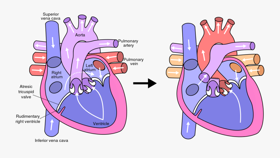 Transparent Circulatory System Png - Fontan Operation, Transparent Clipart