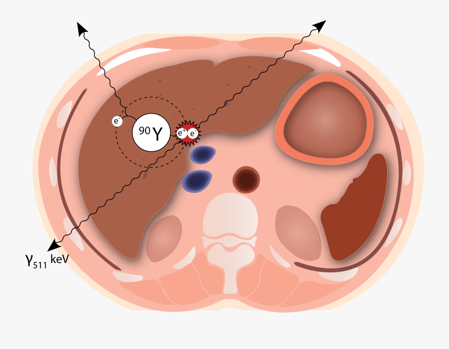 Liver Clipart Lever - Radioembolization Yttrium 90, Transparent Clipart