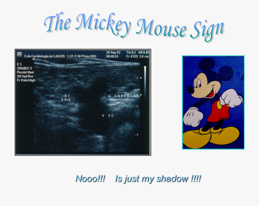 Transparent Mickey Mouse Symbol Png - Dilation Of Mickey Mouse, Transparent Clipart