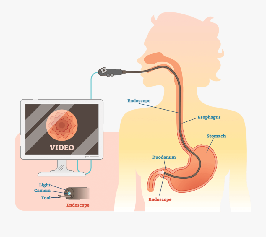 Endoscopic Ultrasound Or Eus Is An Advanced Endoscopic - Endoscopic Ultrasound Procedure, Transparent Clipart