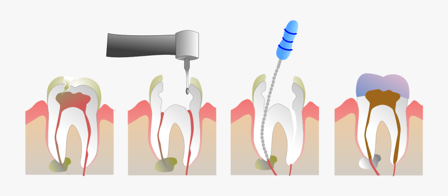 Root Canal, Transparent Clipart