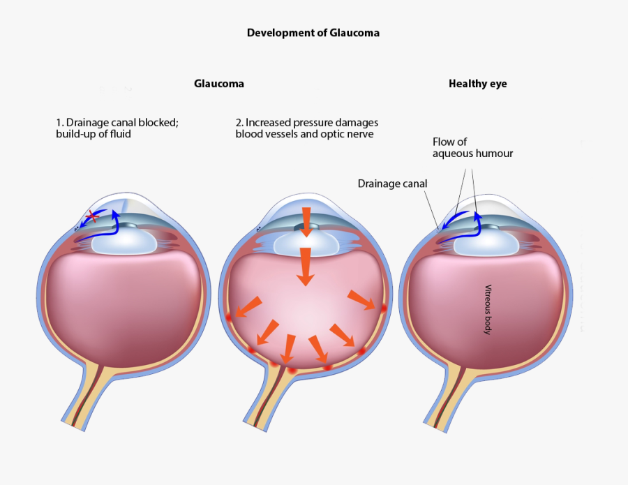 Transparent Chronic Clipart - Laser Cycloablation, Transparent Clipart