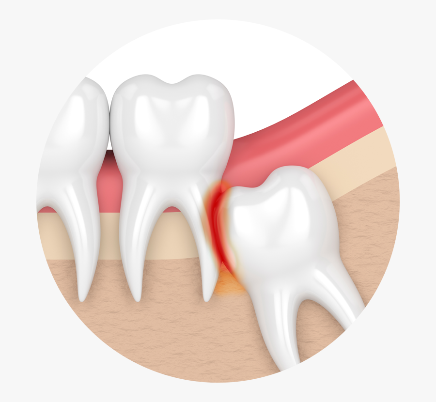 My Teeth Are Becoming Transparent Impaction Teeth Png - Wisdom Teeth, Transparent Clipart