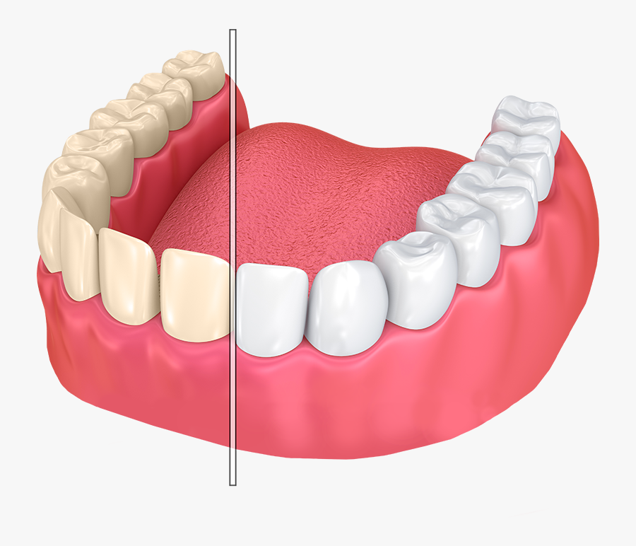 Dentures Transparent Png - Teeth Whitening Illustration, Transparent Clipart