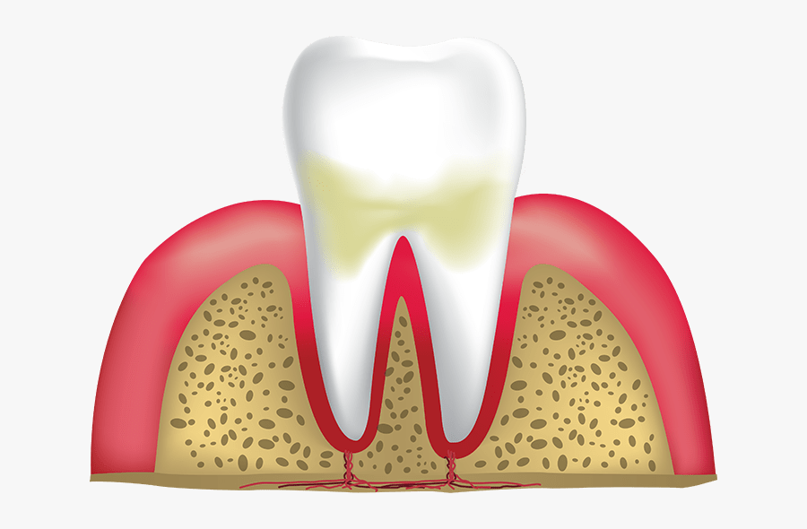 Gingivitis Lafayette In - Gingivitsi Png, Transparent Clipart
